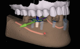 X-guide 3D model from McNickle Family Dentistry